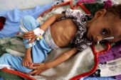 مقام سازمان‌ملل: 400 هزار کودک یمنی به دلیل سوء تغذیه با مرگ فاصله‌ای ندارند
