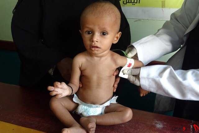سازمان بهداشت جهانی: سه چهارم کودکان یمن از سوء تغذیه مزمن رنج می برند