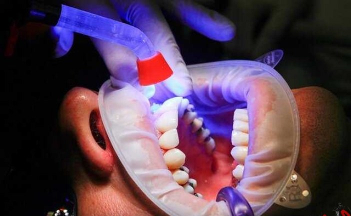 ایجاد مینای دندان با سلول‌های بنیادی